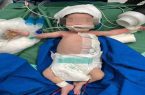 انجام موفقیت‌آمیز عمل جراحی کیست مادرزادی جدار شکم بر روی نوزاد ۱۱ روزه