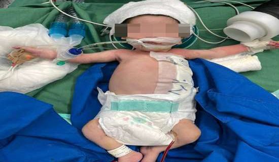 انجام موفقیت‌آمیز عمل جراحی کیست مادرزادی جدار شکم بر روی نوزاد ۱۱ روزه